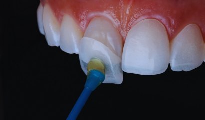 Dental Veneers Tirupati